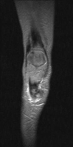 Osteoclastoma Image Radiopaedia Org