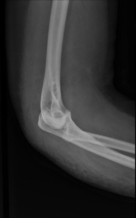 Elbow Dislocation With Radial Head Fracture Image Radiopaedia Org