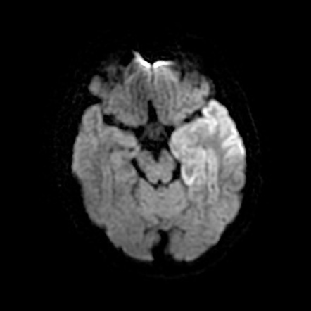 Herpes Simplex Encephalitis Radiology Reference Article Radiopaedia Org