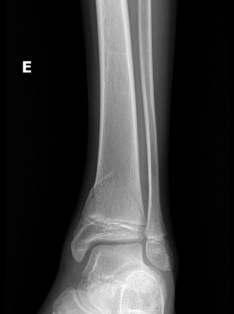 Salter Harris Type Ii Fracture Of Distal Tibia Image Radiopaedia Org