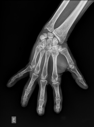 PIP Joint Dislocation With Volar Plate Avulsion Fracture Image