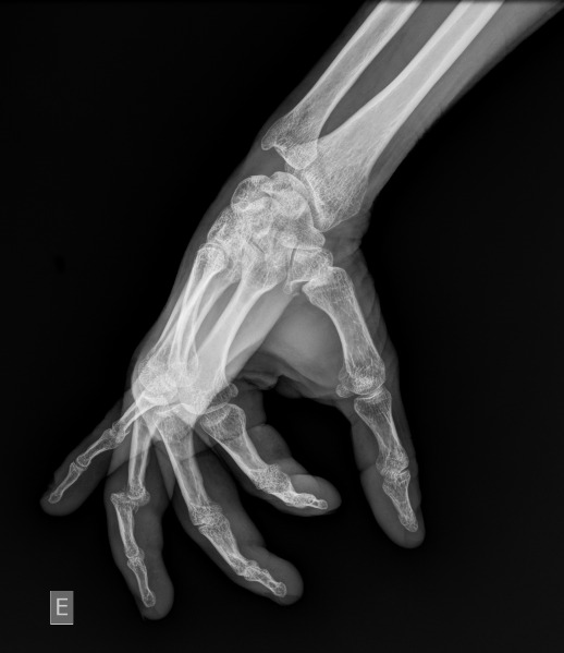 Pip Joint Dislocation With Volar Plate Avulsion Fracture Image