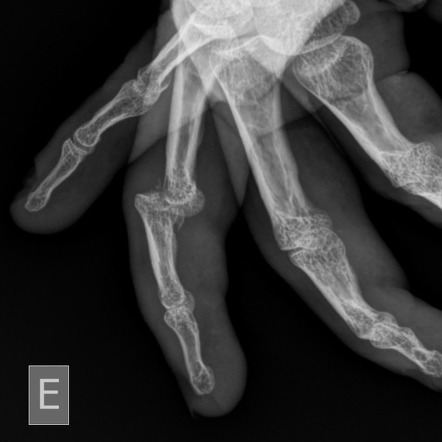 Pip Joint Dislocation With Volar Plate Avulsion Fracture Radiology