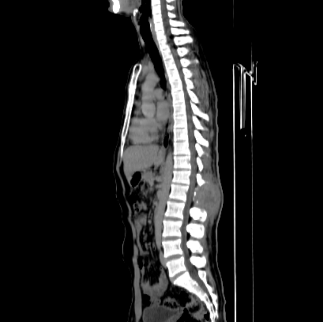 Spinal Epithelioid Angiosarcoma Image Radiopaedia Org