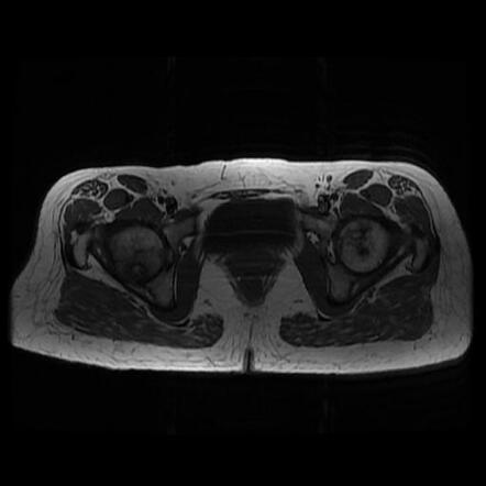 Avascular Necrosis Of Hip Joint Bilateral Radiology Case