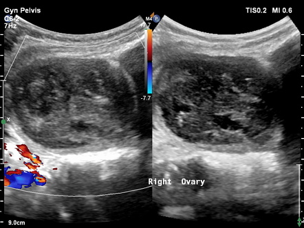 Granulosa Cell Tumor Ovarian Radiology Case Radiopaedia Org