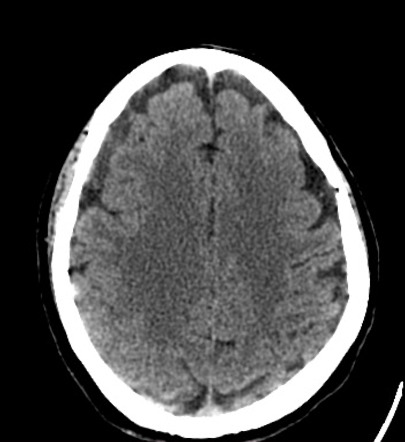 Subacute Subdural Haematoma Radiology Case Radiopaedia Org