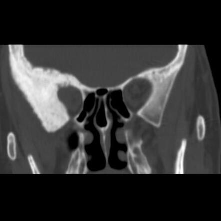 Spheno Orbital And Calvarium Intraosseous Meningioma Radiology Case