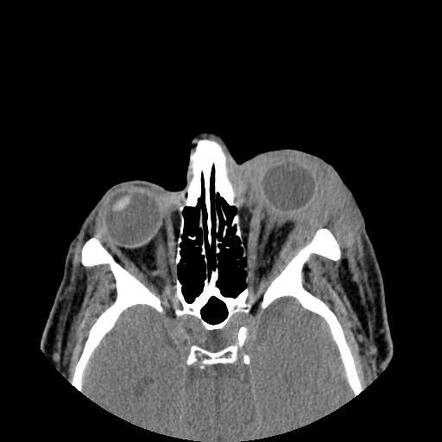 Adenoid Cystic Carcinoma Of Lacrimal Gland Image Radiopaedia Org