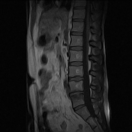 Acute Schmorl Node Image Radiopaedia Org