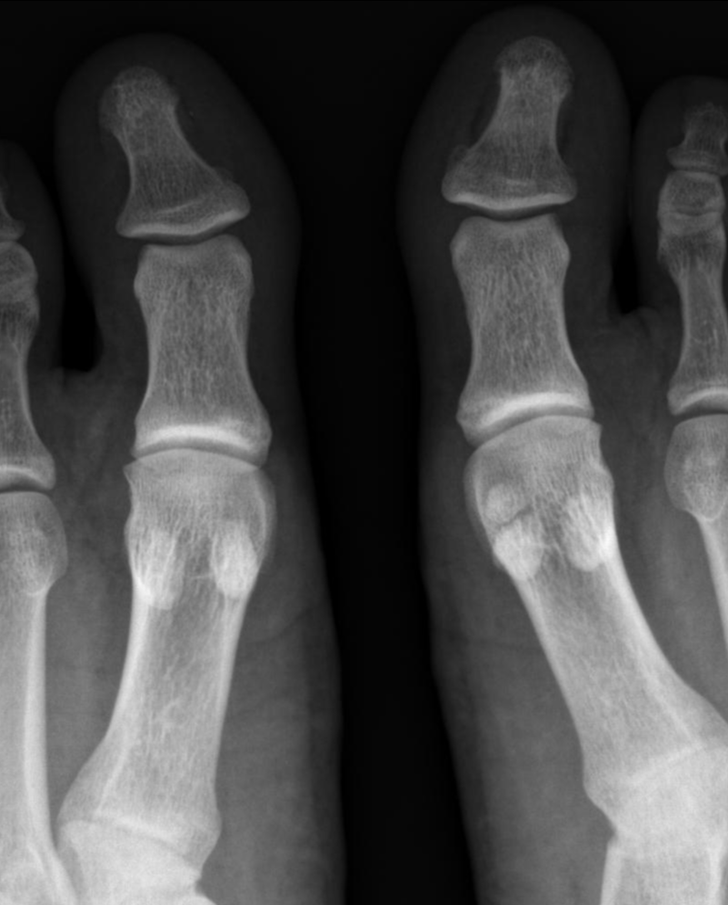 Bipartite Hallux Sesamoid Image Radiopaedia Org