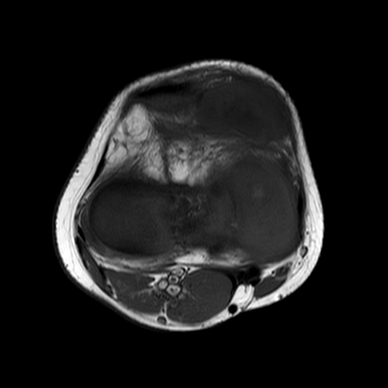 Synovial Chondromatosis Image Radiopaedia Org