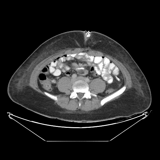 Closed Loop Small Bowel Obstruction Adhesive Band Image