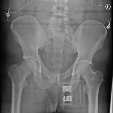 Pubic Symphysis Disruption Image Radiopaedia Org