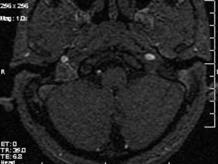 Vertebral Artery Thrombosis Radiology Reference Article Radiopaedia Org