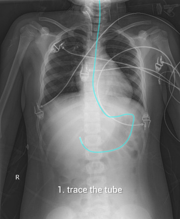 Nasogastric Tube Position Confirmation Image Radiopaedia Org