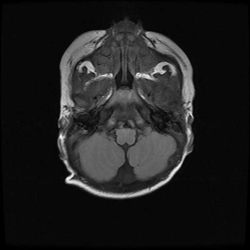 Periventricular Nodular Gray Matter Heterotopia Image Radiopaedia Org