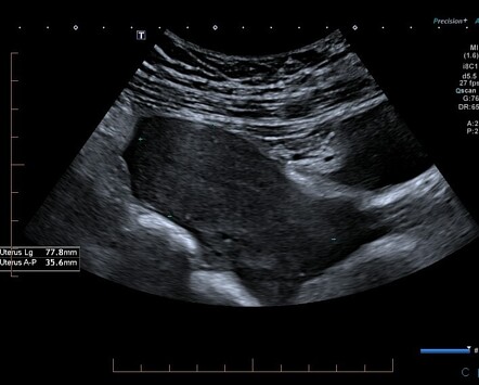 Ruptured Ectopic Pregnancy Radiology Case Radiopaedia Org