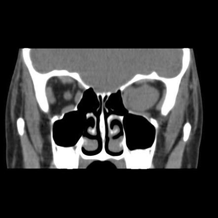 Schwannoma Radiology Reference Article Radiopaedia Org