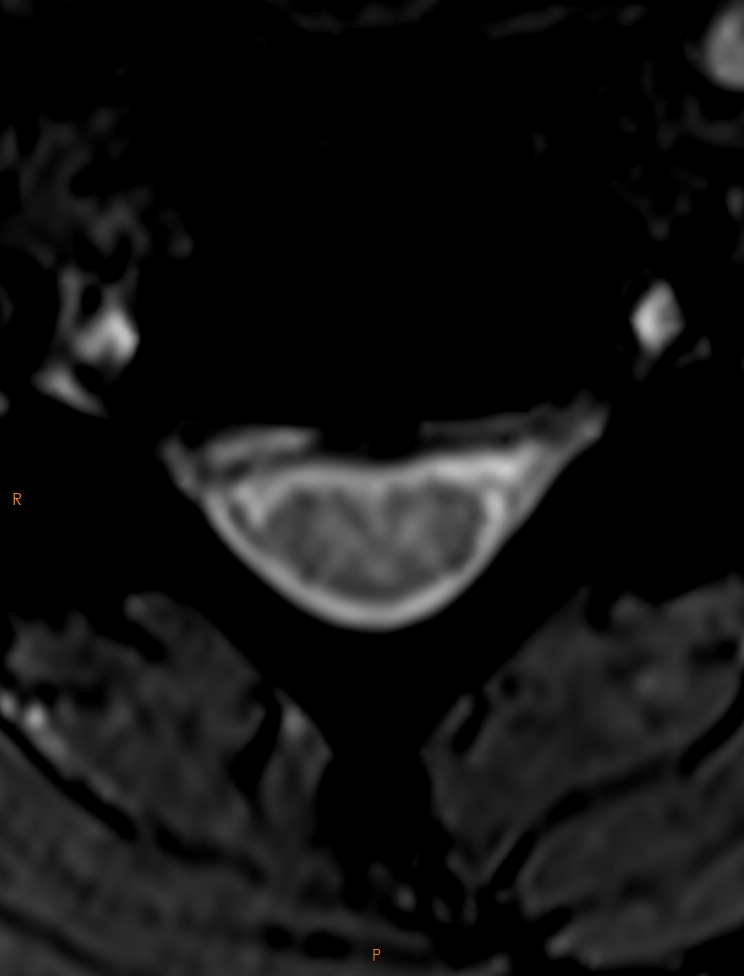 Cervical Disc Protrusion With Cord Compression Image Radiopaedia Org