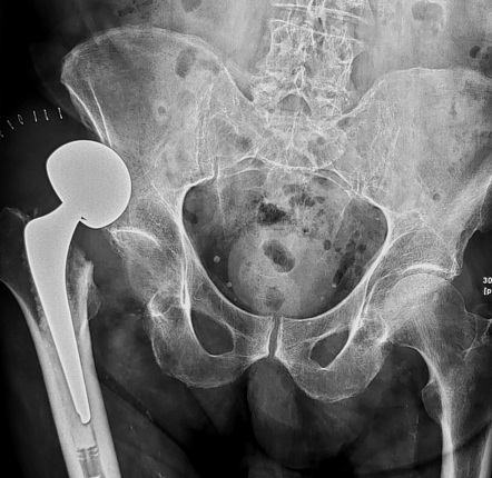 Complications Of Total Hip Arthroplasty Radiology Reference Article Radiopaedia Org