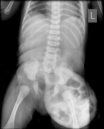 Congenital Umbilical Hernia Radiology Case Radiopaedia Org