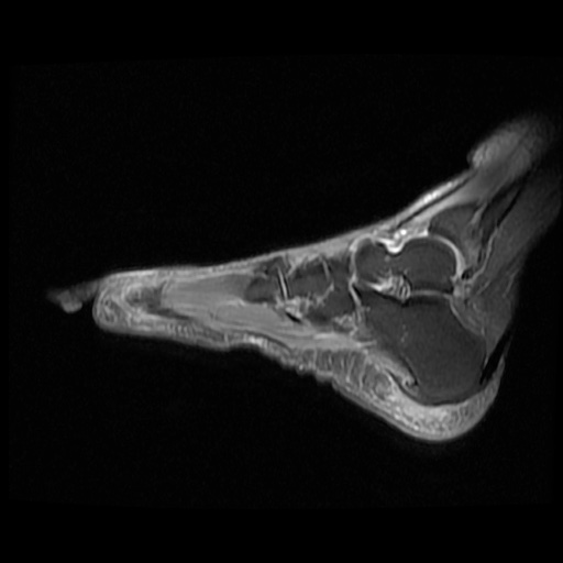 Morton Neuroma Image Radiopaedia Org