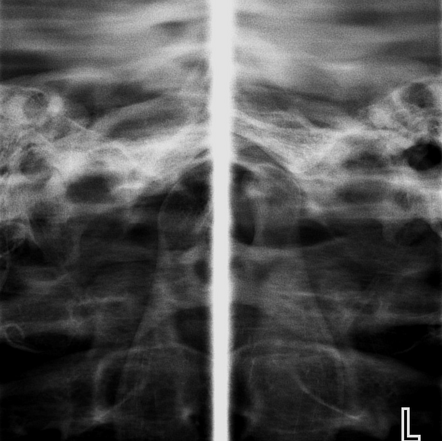 Bilateral Temporomandibular Joint Dislocation Radiology Case