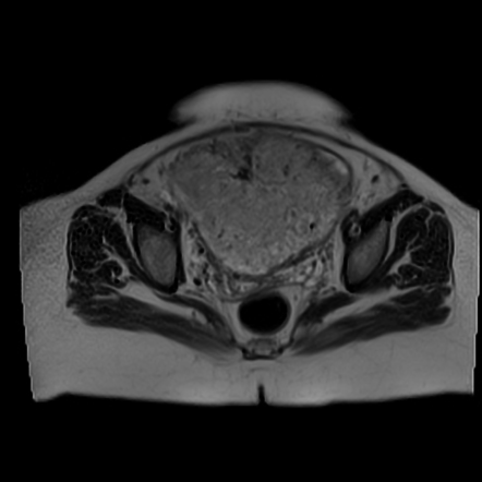 Placenta Accreta Image Radiopaedia Org