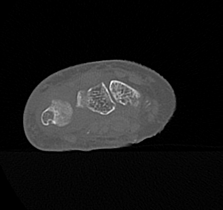 Galeazzi Fracture Dislocation Chronic Image Radiopaedia Org