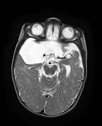 Arachnoid Cyst Middle Cranial Fossa Radiology Case Radiopaedia Org