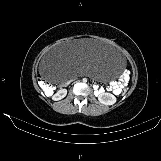 Ovarian Serous Cystadenoma Image Radiopaedia Org