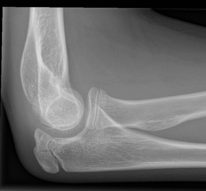 Radial Neck And Olecranon Fractures Image Radiopaedia Org