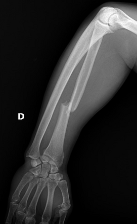 Galeazzi Fracture Dislocation Image Radiopaedia Org