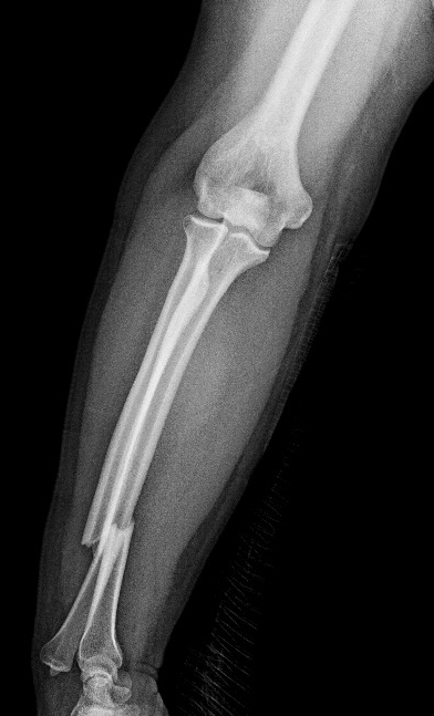 Galeazzi Fracture Dislocation Image Radiopaedia Org