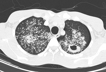 Pulmonary Tuberculosis Radiology Case Radiopaedia Org