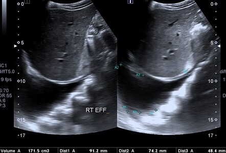 Pyelonephritis Image Radiopaedia Org