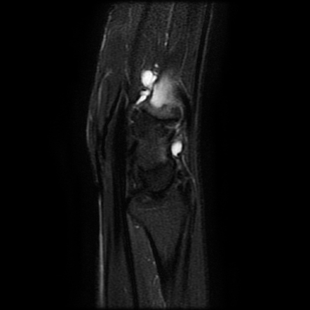 Unicameral Bone Cyst Image Radiopaedia Org