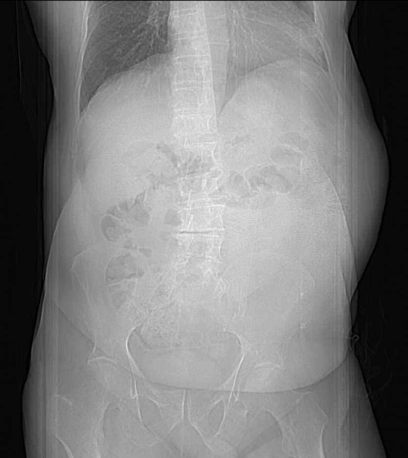 Gallstone Ileus Image Radiopaedia Org