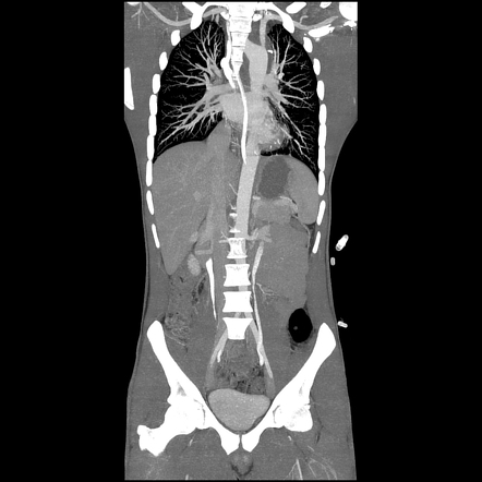 Aortic Arch Traumatic Pseudoaneurysm Image Radiopaedia Org