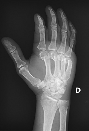 Metacarpal Neck Fractures Radiology Case Radiopaedia Org