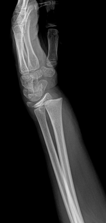 Salter Harris Type I Fracture Of Distal Radius Radiology Case