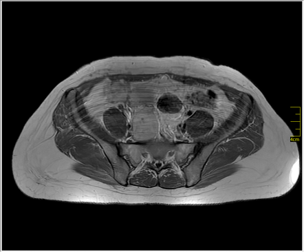 Sacral Schwannoma Radiology Case Radiopaedia Org