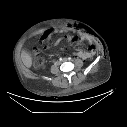 Fournier Gangrene Image Radiopaedia Org