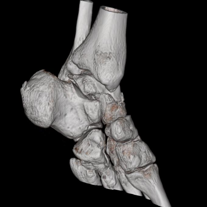 Concomitant Talus Bone Neck And Cuboid Bone Fractures Image