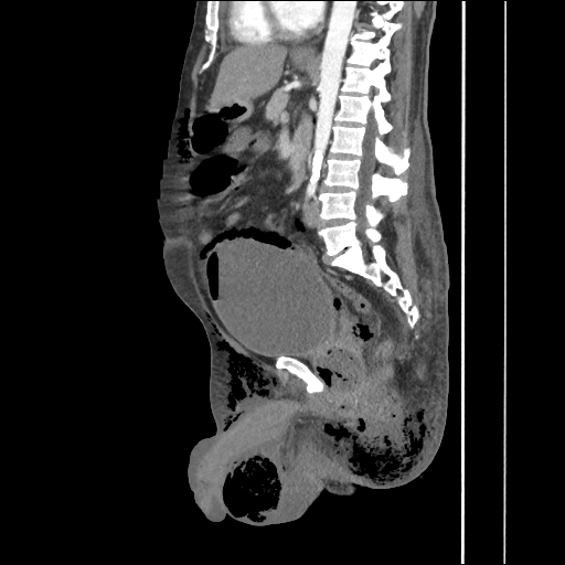 Fournier Gangrene Image Radiopaedia Org