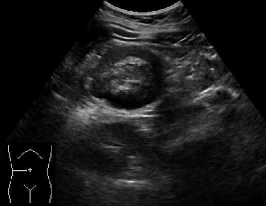 Colocolic Intussusception Due To Mucinous Carcinoma Of The Colon