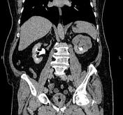 Clear Cell Renal Cell Carcinoma Radiology Reference Article