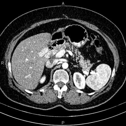 Whipple Procedure Radiology Reference Article Radiopaedia Org