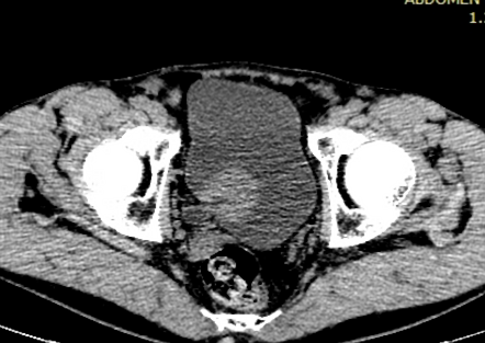 Urinary Bladder Tumour Radiology Case Radiopaedia Org